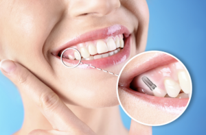 single tooth dental implant