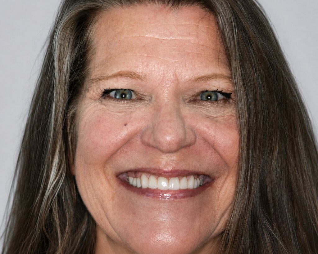 Susan After Photo - Smile Makeover in Leander, TX